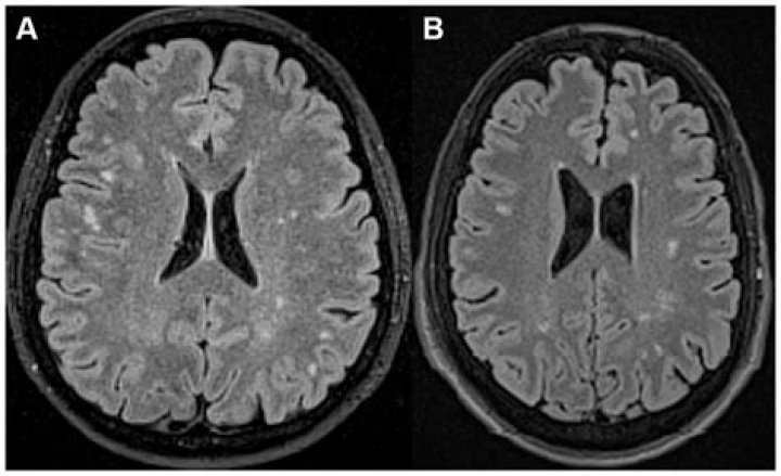Can migraines be detected on MRI?