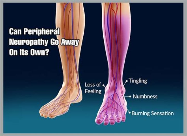 Can neuropathy in feet go away?