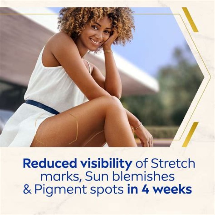 Can Nivea cream remove stretch marks?
