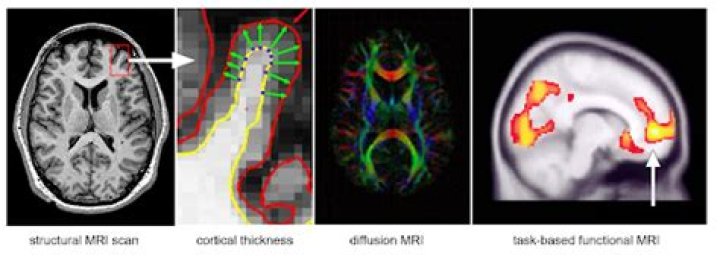 Can OCD be seen on MRI?