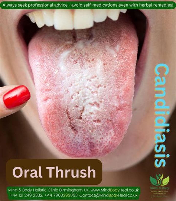 Can oral thrush cause swollen salivary glands?
