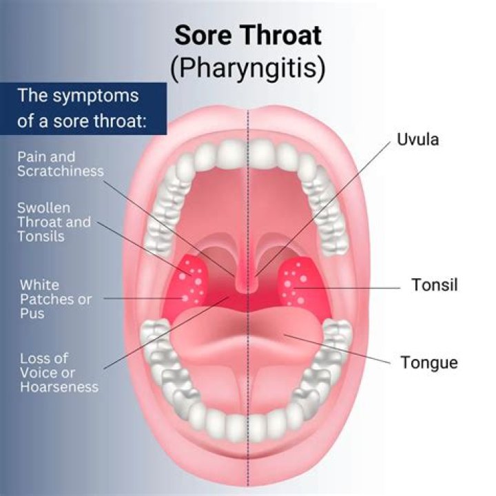 Can parasites cause a sore throat?