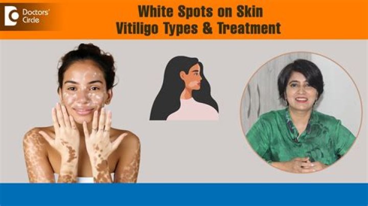 Can pigment come back with vitiligo?