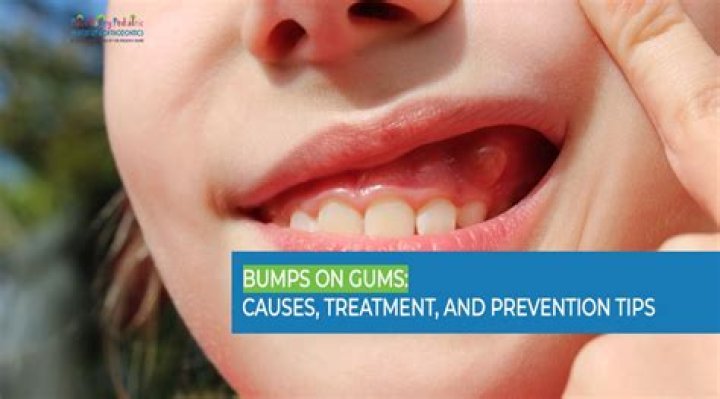 Can popcorn cut your gums?