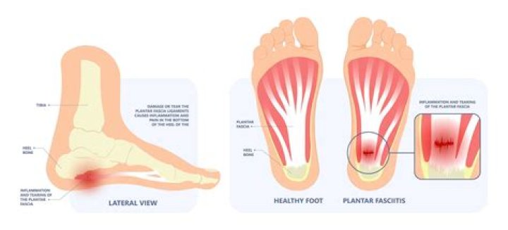 Can rock climbing cause plantar fasciitis?