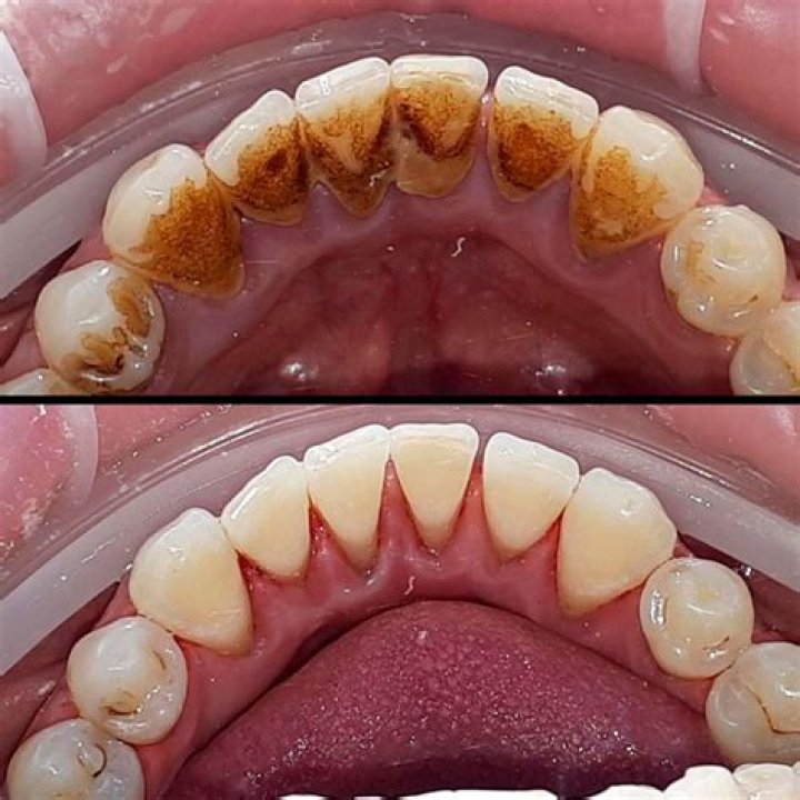 Can tartar break off?