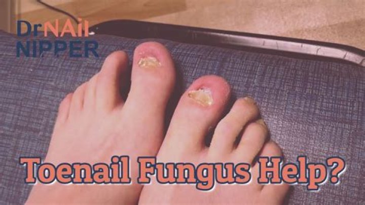 Can toenail fungus be cured?