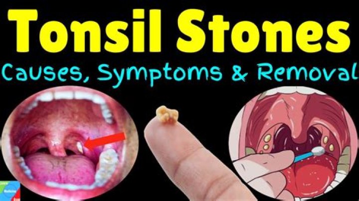 Can tonsil stones leave holes?