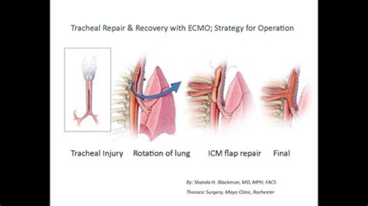 Can tracheal collapse happen suddenly?