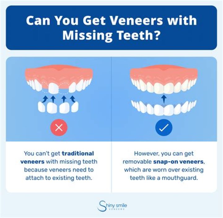 Can veneers be put on loose teeth?