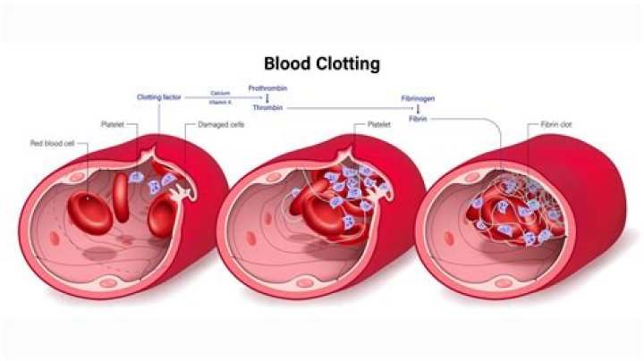 Can vitamin D cause blood clots?