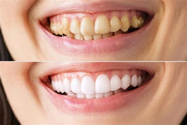 Can yellow teeth get white again?