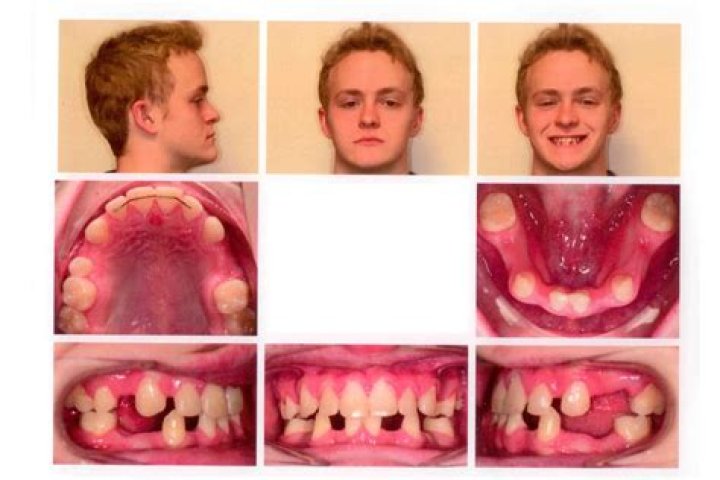 Can you be born without teeth?