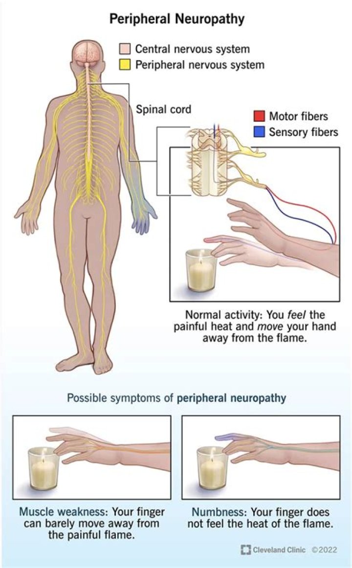 Can you become paralyzed from peripheral neuropathy?