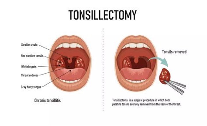 Can you brush teeth after tonsillectomy?