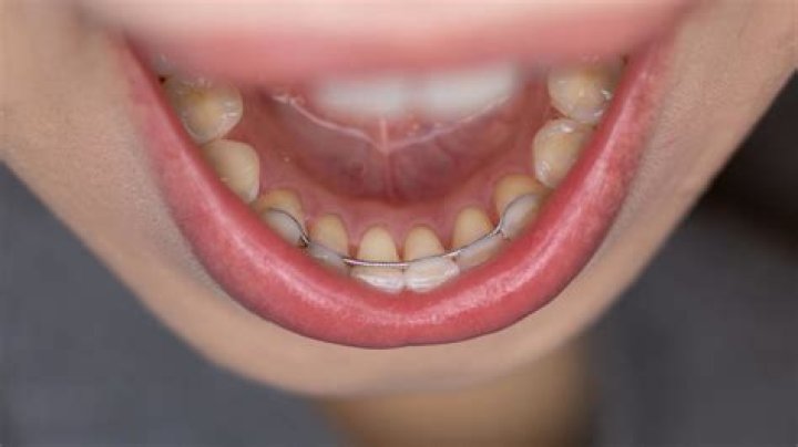 Can you eat steak with a permanent retainer?