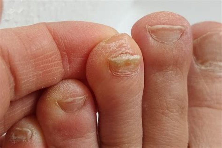 Can you file away nail fungus?