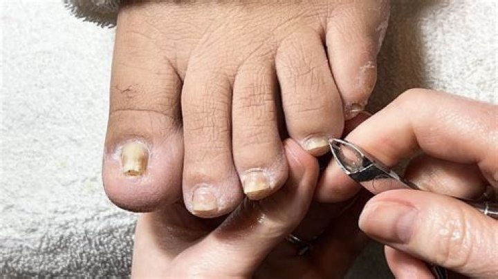 Can you fix pincer toenails?