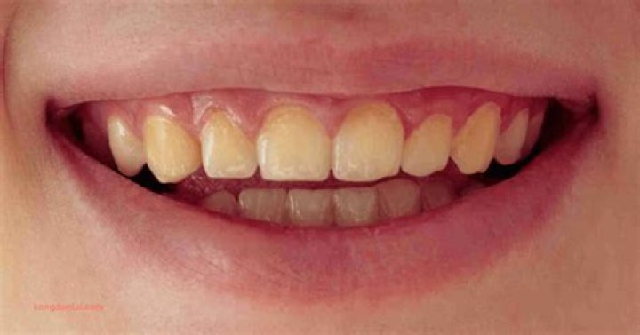 Can you fix yellowed teeth?