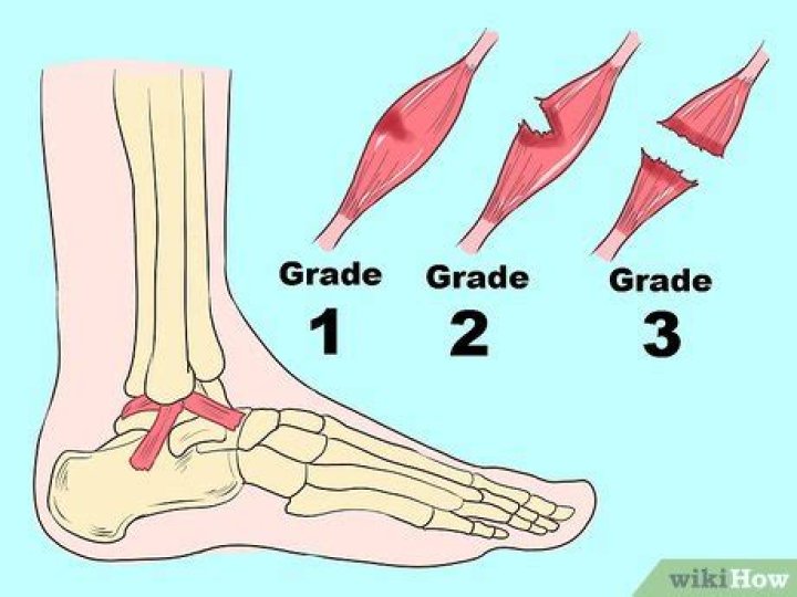 Can you fully recover from a grade 3 ankle sprain?