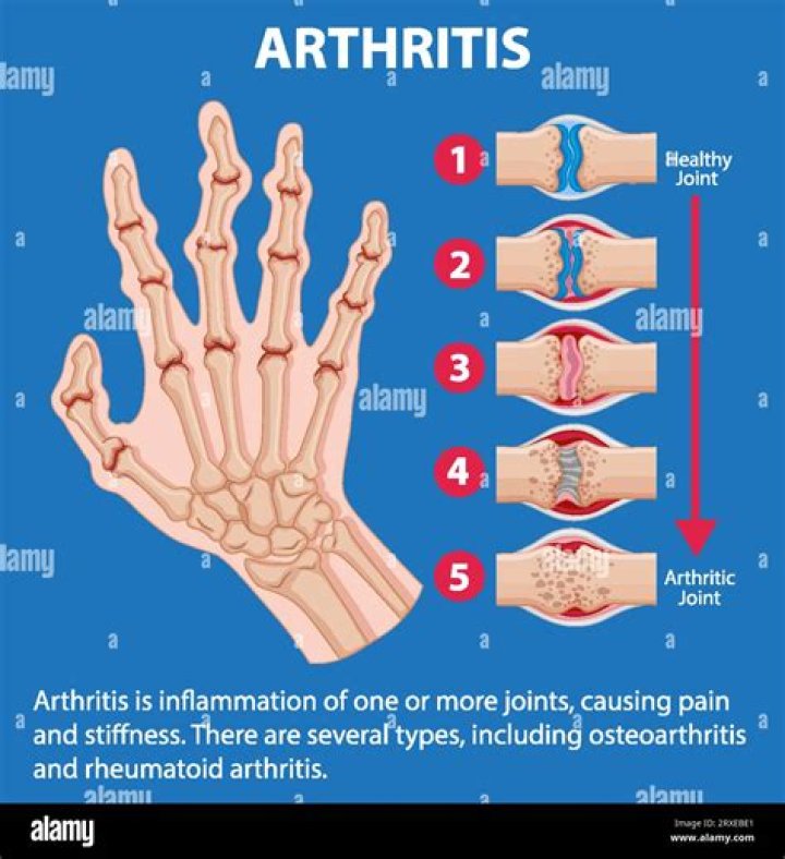 Can you get arthritis at any age?