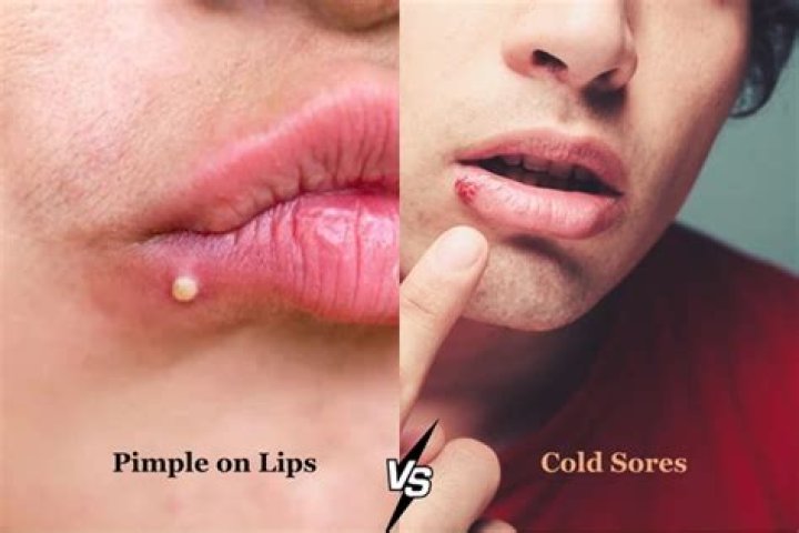 Can you get pimples on your lip from kissing?