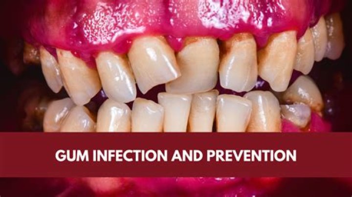 Can you have a gum infection for years?