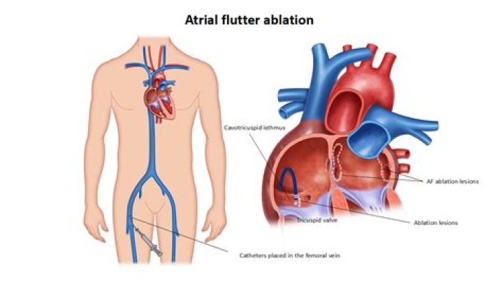 Can you have ablation twice?