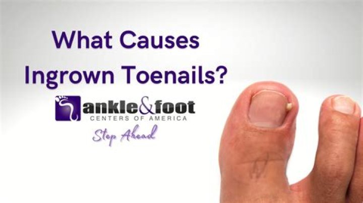 Can you leave ingrown toenails alone?