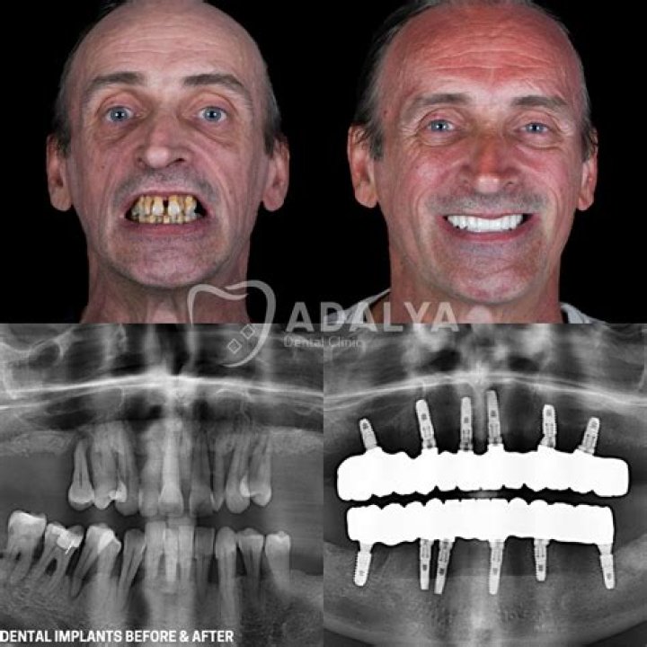 Can you put implants in front teeth?