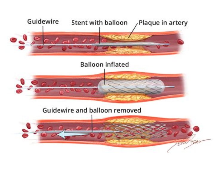 Can you reverse plaque buildup in your arteries?
