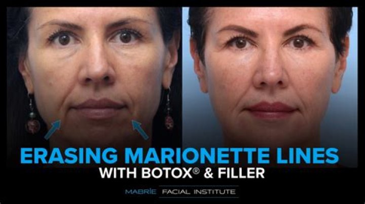 Can you use Botox for marionette lines?