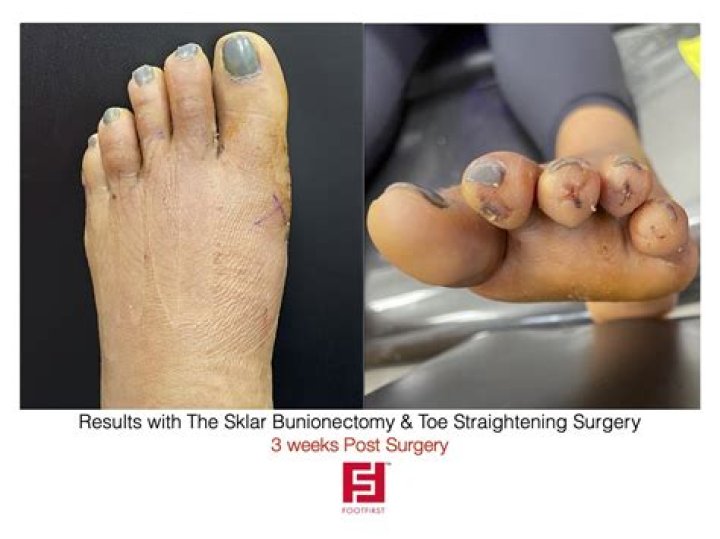 Can you walk after toe shortening surgery?