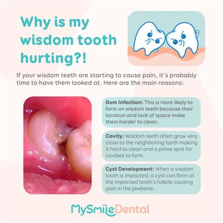 Can your wisdom teeth come in in your 30s?