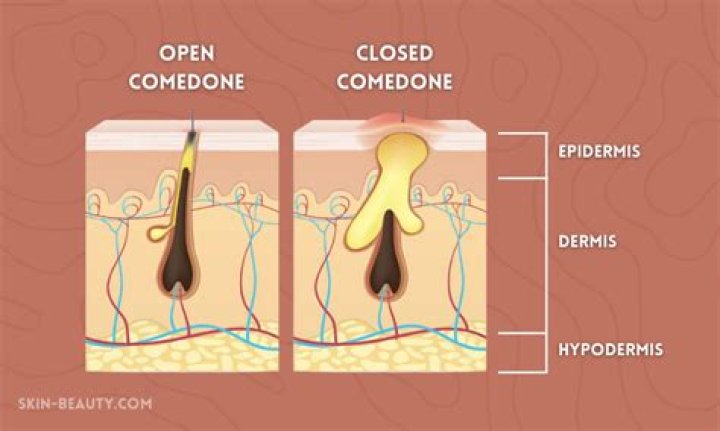 Do closed comedones have pus?