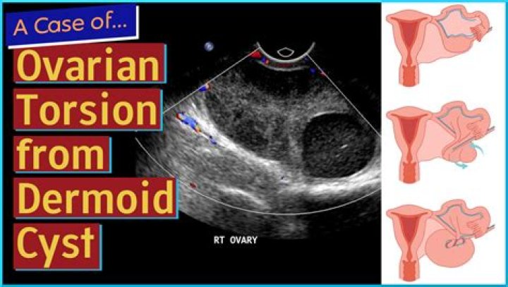 Do dermoid cysts grow faster during pregnancy?