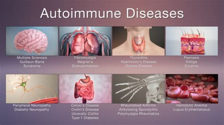 Do endocrinologist treat autoimmune diseases?