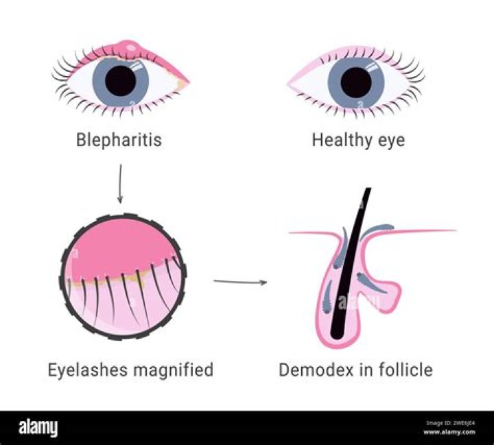 Do eyelashes grow back after blepharitis?