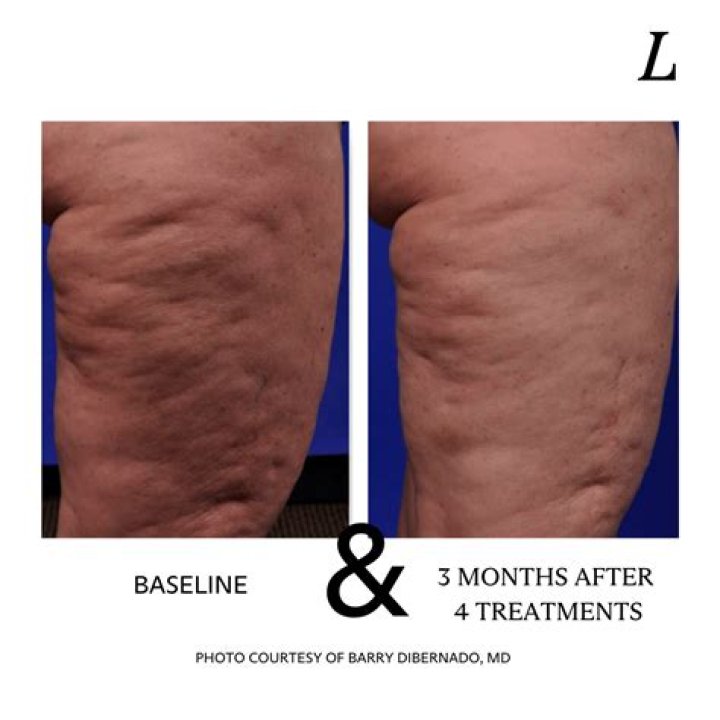 Do fitness models have cellulite?
