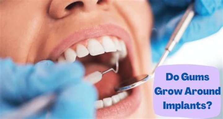 Do gums grow around implants?