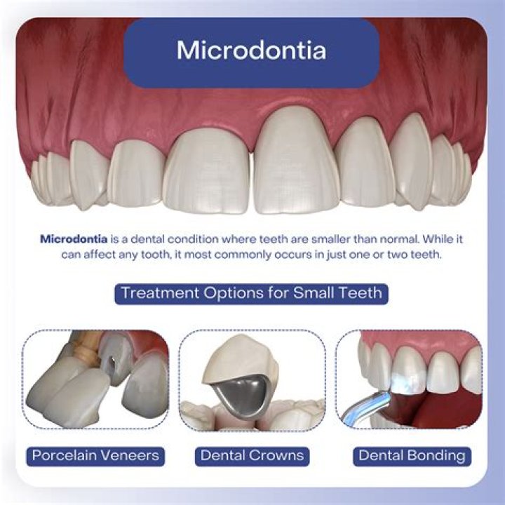 Do I have microdontia?