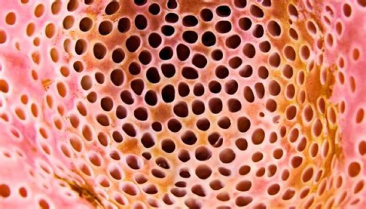 Do I have Trypophobia?