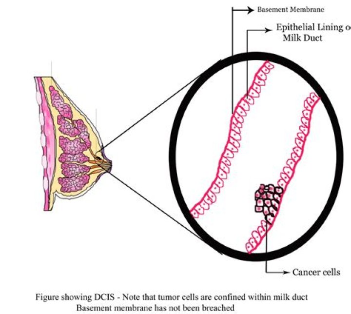 Do I need a mastectomy for DCIS?