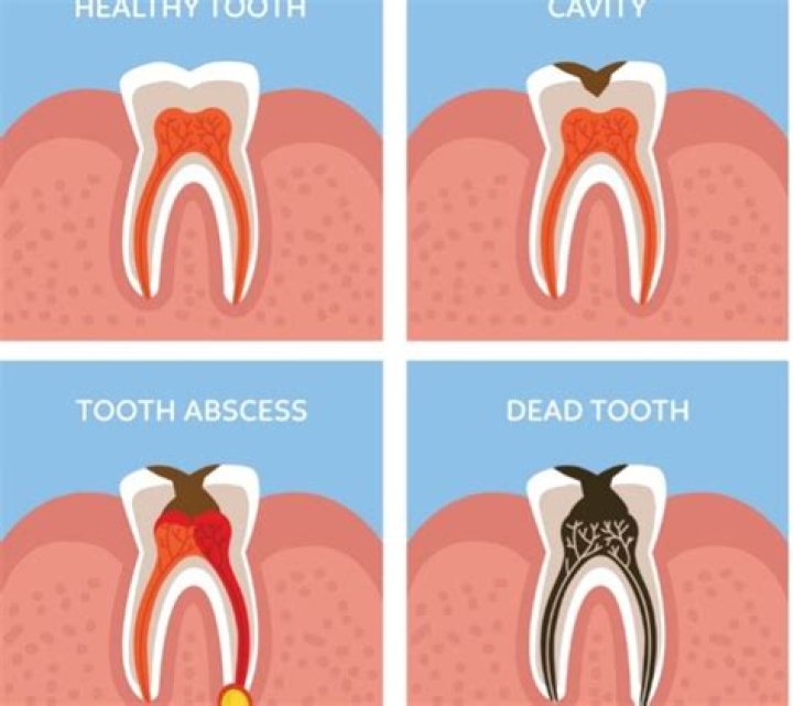 Do I need a root canal if there is no pain?