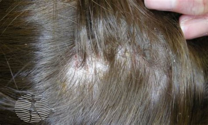 Do lice bite your scalp?