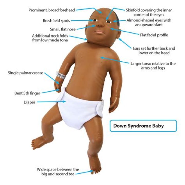 Do most Down syndrome babies miscarry?