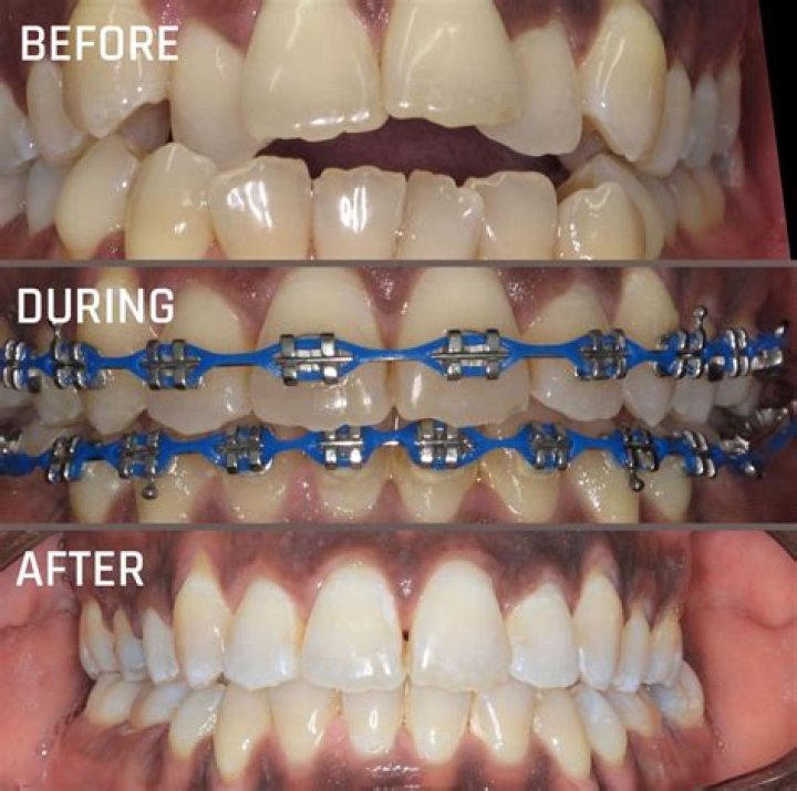 Do teeth stain with braces?