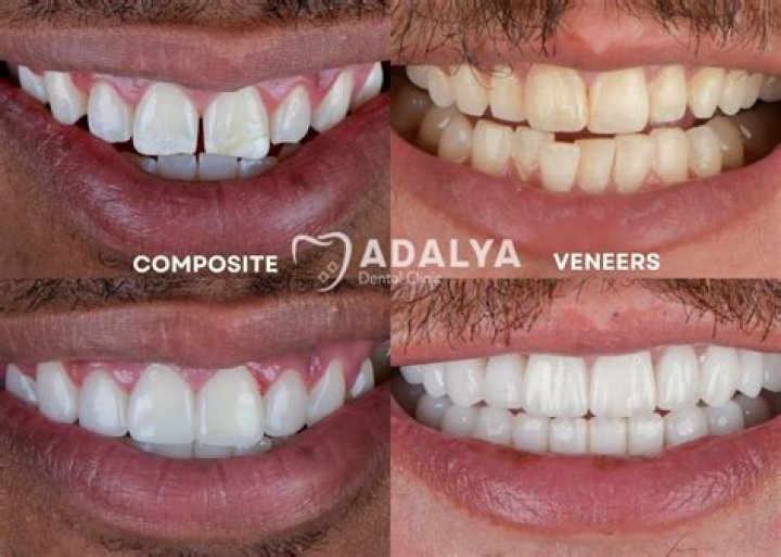 Do temporary veneers smell?