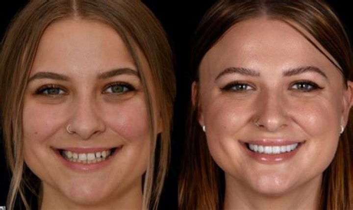 Do veneers change your face?