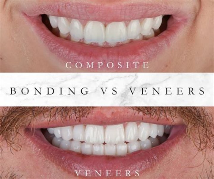 Do veneers last longer than composite?